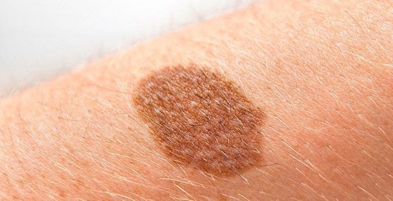 El cáncer de piel es el tumor más frecuente