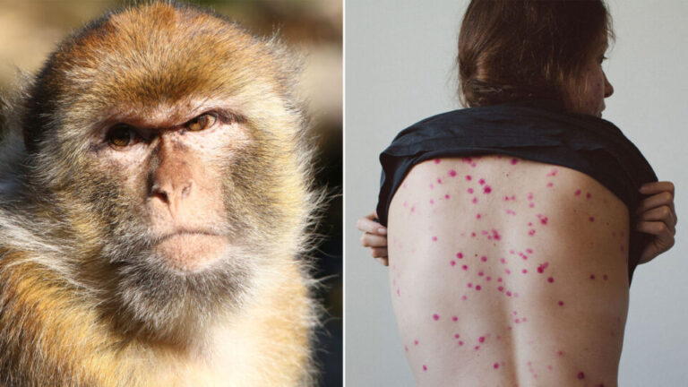 Salud Pública informa de un caso sospechoso de viruela del mono en la Comunidad