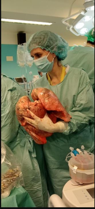 Trasplante pulmonar en Valladolid